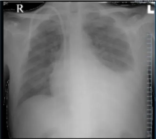 Foto Thorax AP : 