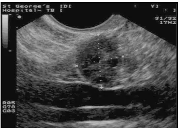 Gambar 2.4 USG Ovarium normal (Sumber: Jermy dan Bourne, 2003)  Morfologi  dan  volume  ovarium  bergantung  pada  beberapa  faktor  diantaranya umur dan status menopause pasien