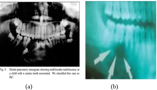 Gambar 3.  (a) Gambaran ameloblastoma multilokular dengan panoramik foto, memperlihatkan kelainan di regio caninus pada  pasien anak