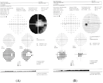 Gambar 1. Gambaran hasil pemeriksaan lapang pandang dengan Humphrey 30-2, program SITA standard mata kanan (A) dan mata kiri (B) 