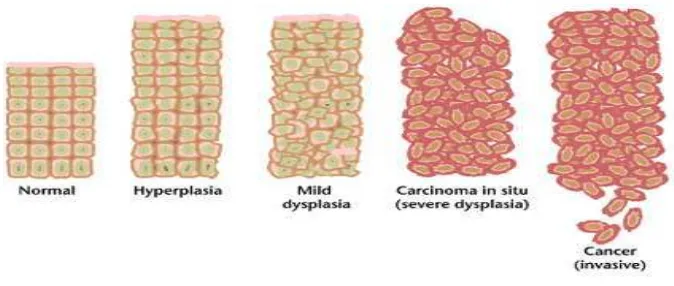 Gambar 2.  Perkembangan sel normal menjadi sel kanker (Anand and Kunnumakkara, 2008). 
