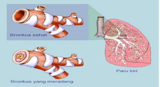 Gambar 2. 1 Perbedaan dari normal bronki versus bronkitis(Widiyanti,2011). 