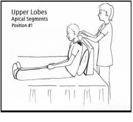 Gambar 2.3 Postural drainage upper lobus apical segments 