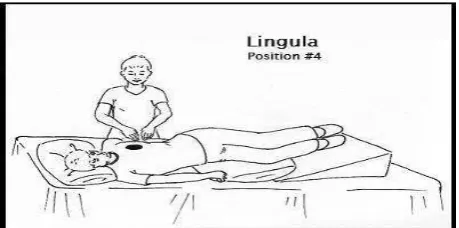 Gambar 2.6            Postural drainage lobus lingual 