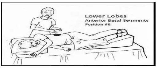 Gambar 2.7                Postural drainage middle lobus 