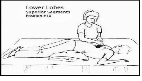 Gambar 2.9 Postural drainage lower lobus superior segments 