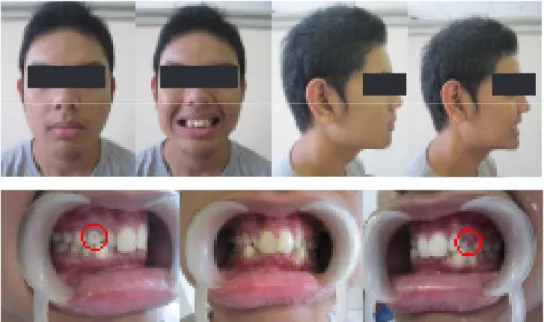 Gambar 1. Foto intraoral dan ekstraoral sebelum perawatan,tampak gigi kaninus permanen belum  erupsi, dan gigi kaninus desidui belum tanggal