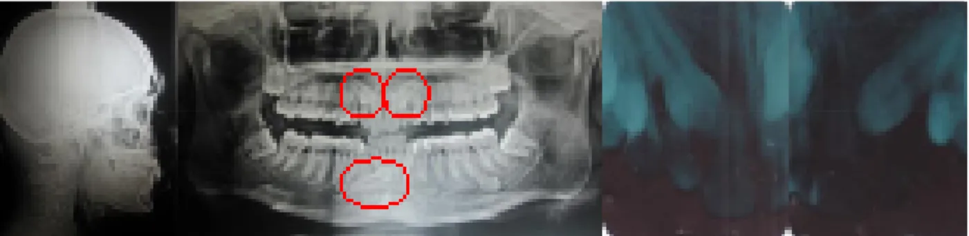 Gambar 3. Radiografi sebelum perawatan, gigi kaninus permanen kanan kiri atas dan kanan bawah impaksi