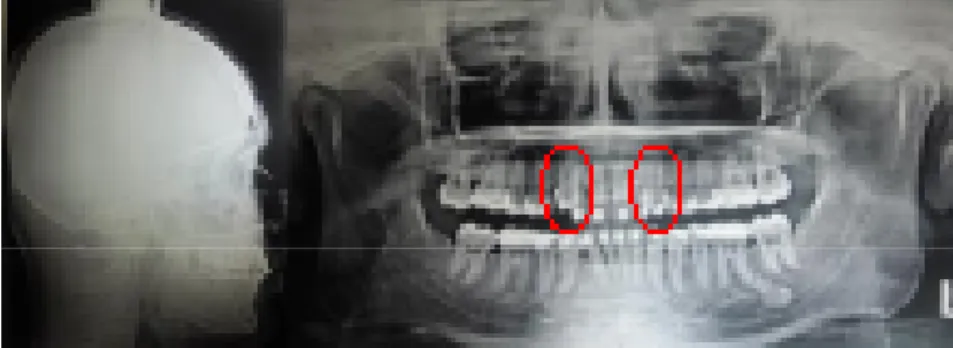Gambar 6. Rontgen foto selama perawatan, gigi kaninus permanen sudah berada pada  posisi yang tepat