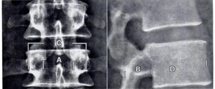 Gambar  2.4    Foto  radiografi  vertebra  lumbal  anteroposterior  dan  lateral.  A-jarak  antar  pedicle