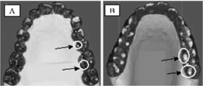 Gambar 2. Pola tooth grinding pada sisi MG, A: kontak  mediotrusi, B: mediotrusive grinding 16