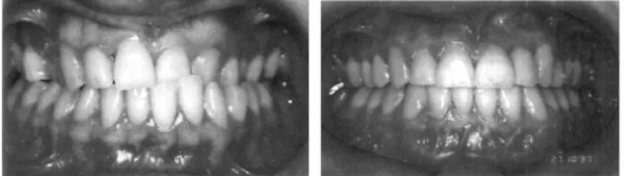 Gambar 1. Foto intraoral sebelum dan setelah perawatan dengan pembukaan ruangan,  agenesis insisif lateral  digantikan dengan single tooth implant (Sumber: Roy Sabri) 9