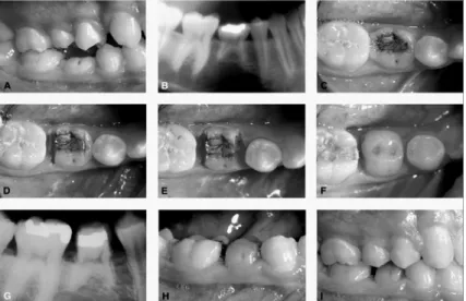 Gambar 4. Pasien wanita dengan agenesis premolar 2 bawah, terdapat molar 2 sulung bawah dan terbenam di  bawah bidang oklusal