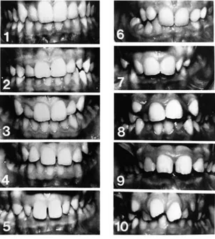 Gambar  1.  Skala  estetik  dari  IOTN  (Index  of  Orthodontic Treatment Nee)²