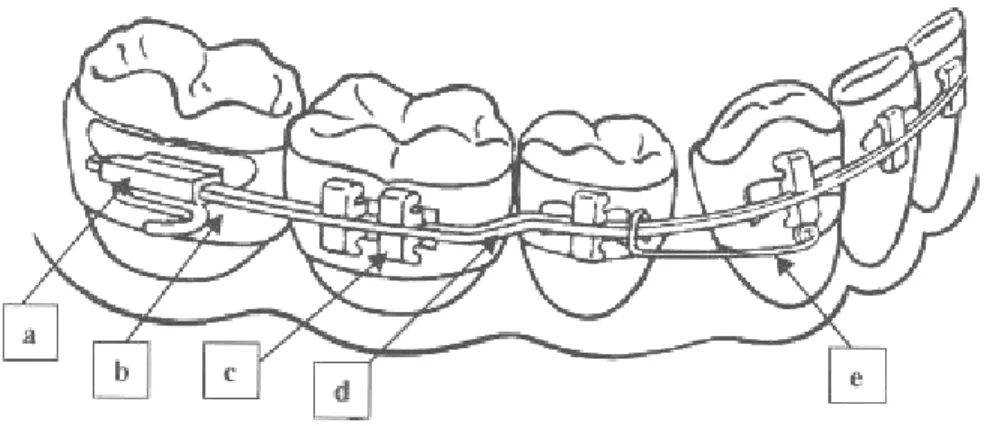 Gambar 1 : Alat Ortodontik Cekat 