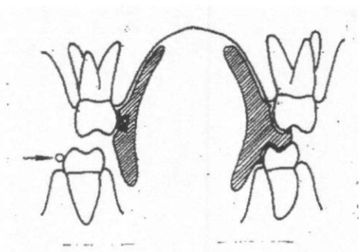 Gambar 6 : Dengan penjangkaran pesawat pada satu sisi dan menggerakkan gigi-gigi pada  sisi yang berlawanan dengan pasak (pegs), pegas, atau penambahan akrilik lunak  (Graber, T.m., Rakosi, Th