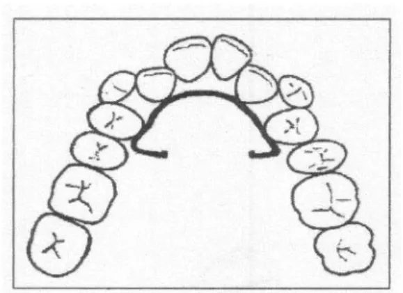 Gambar 23 : Busur lingual atau Mainwire 