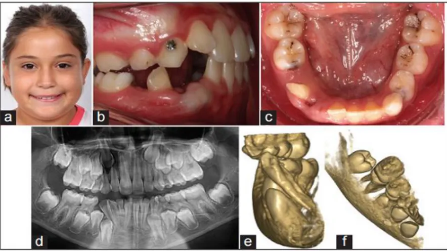 Gambar 4: (a-f)  Gambaran intraoral/ ekstraoral serta radiografi pasien sebelum  dilakukan perawatan orthodontik