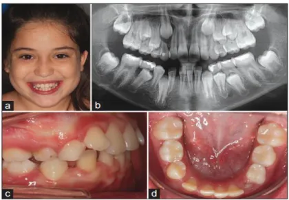 Gambar 6: (a-d) Gambaran intraoral/ ekstraoral serta radiografi pasien setelah dilakukan  perawatan orthodontik
