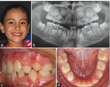 Gambar 3: (a-d) Foto intraoral, ekstraoral serta radiografi pasien setelah perawatan orthodontik 