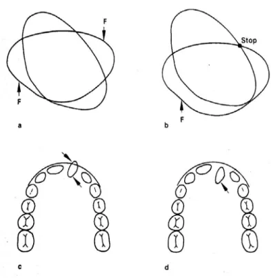 Gambar 2 : Dua metode untuk merotasi sebuah gigi (a) dengan  memakai  kekuatan gabungan (b) menggunakan  kekuatan tunggal dan sebuah “ stop “