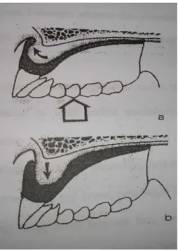 Gambar 5. (a) Dibawah tekanan oklusal, gigi tiruan atas terletak pas dan prosesus   Alveolaris daerah anterior yang kenyal dalam keadaan tertekan 