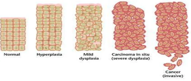 Gambar 2.  Perkembangan sel normal menjadi sel kanker (Anand and Kunnumakkara, 2008).  