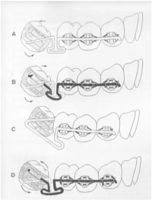 Gambar 7. A) Koreksi mesial tipping gigi molar dengan  cara  distal  crown      tipping,  B)  Koreksi  mesial  tipping 