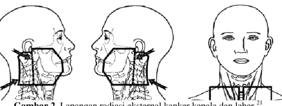 Gambar 2. Lapangan radiasi eksternal kanker kepala dan leher. 21   