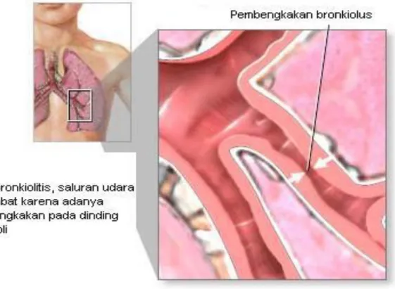 Gambar  Pembengkakan Bronkiolus pada bronkiolitis 