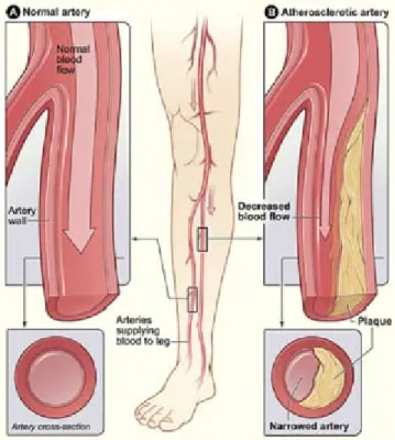 Gambar 4. Peripheral arterial disease 