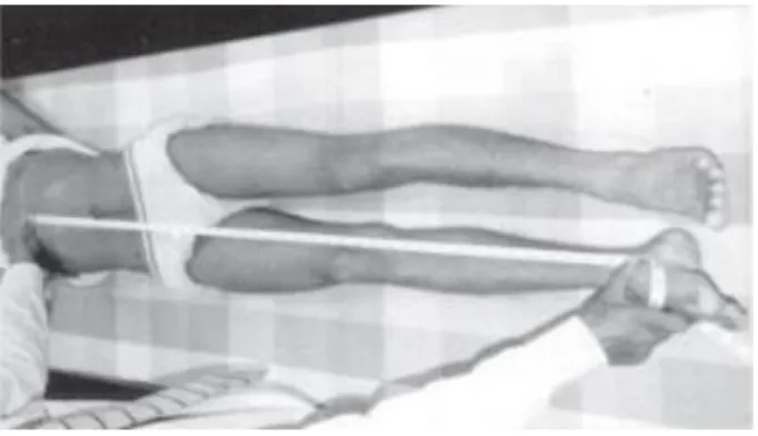Gambar 8. Pengukuran Apparent leg length discrepancy.  4 