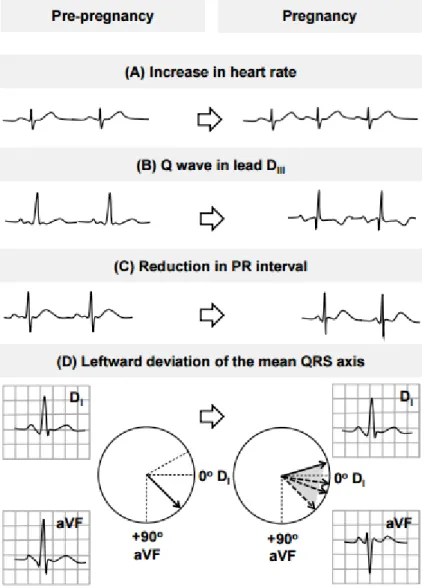 Gambar 2.1. Perbandingan EKG normal pada wanita hamil (Angeli, 2014) 