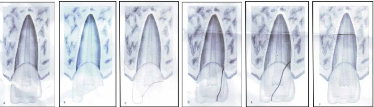 Gambar 1.  A.  Crown infraction dan  uncomplicated fracture  tanpa melibatkan dentin         B