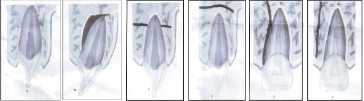 Gambar 3.  A. Comminution of alveolar socket, B. Fraktur pada fasial dan lingual dinding soket  alveolar, C
