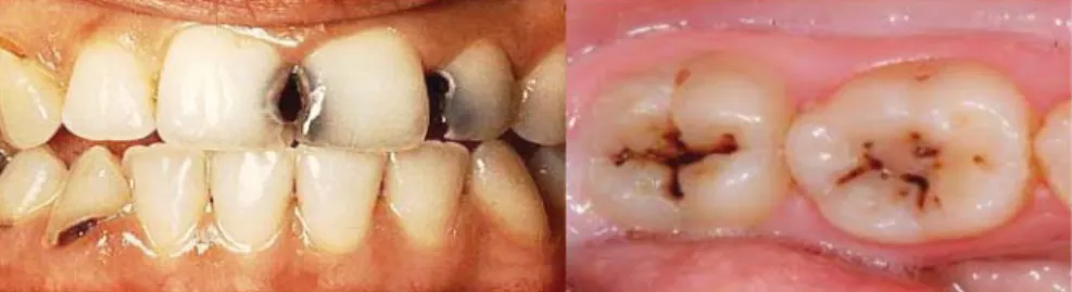 Gambar 3. Gigi berlubang pada gigi seri dan gigi geraham