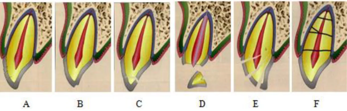 Gambar  1.Kerusakan  pada  jaringan  keras  gigi  dan  pulpa:  A.  Retak  mahkota    B
