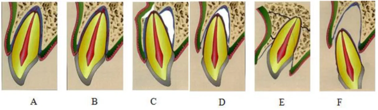 Gambar 2. Kerusakan pada jaringan periodontal: A.Konkusi B. Subluksasi C. Luksasi lateral  D.Luksasi ekstrusi E
