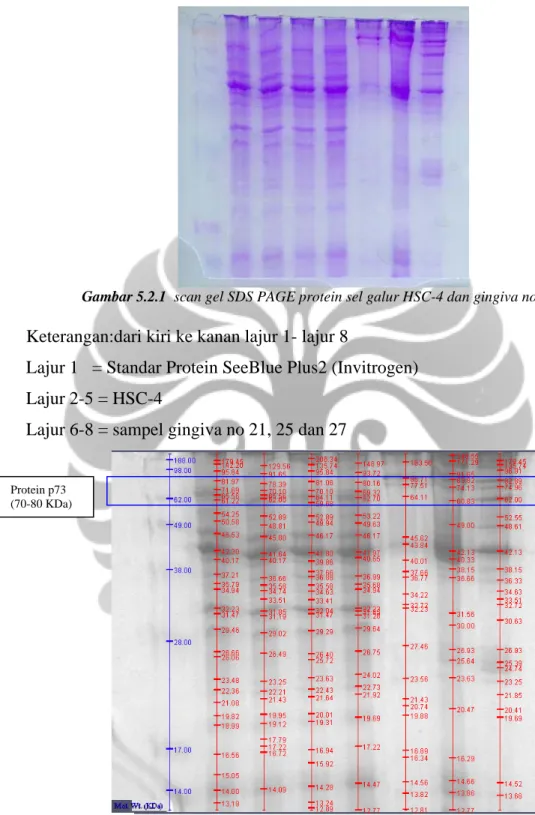 Gambar 5.2.1  scan gel SDS PAGE protein sel galur HSC-4 dan gingiva normal 