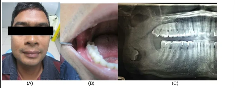 Gambar 1. (A) Foto klinis ekstraoral asimetris; (B) intraoral dalam batas normal; (C) foto OPG menunjukkan gigimolar ketiga mandibula kanan berada di angulus mandibula disertai gambaran radilusen disekitar mahkota gigi