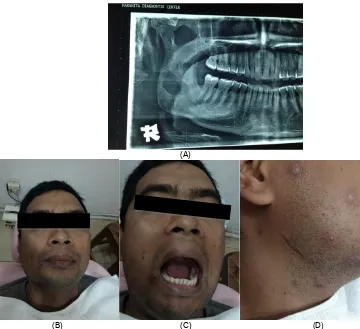 Gambar 3. (A) Hasil foto OPG 3 minggu pasca operasi; (B) profil wajah pasien sudah tampak lebih simetris; (C)tidak ada trismus pasca operasi; (D) bekas luka insisi submandibular tidak ada infeksi.