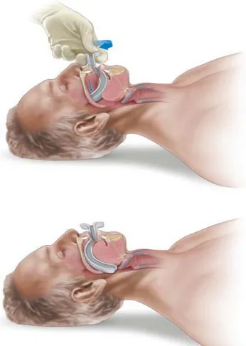 Gambar 2.3 : Oropharyngeal Airway (Sumber : Advance Trauma Life  Support –Students Course Manual, 2009) 