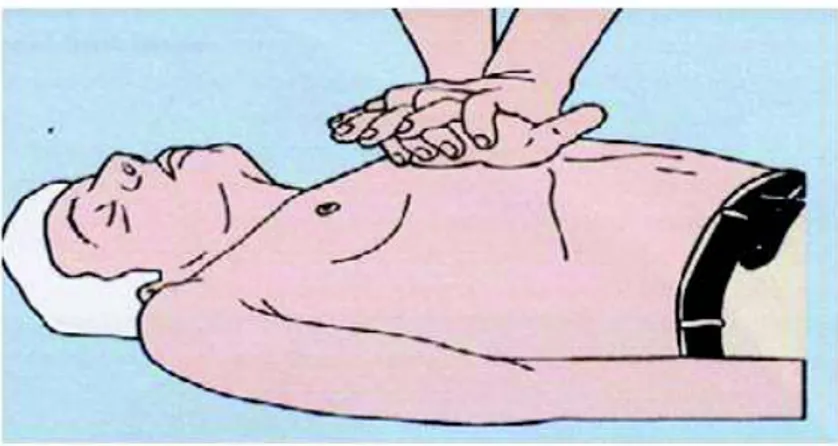 Gambar 4 : Melakukan penekanan dada ( Gobel 2009 ) 