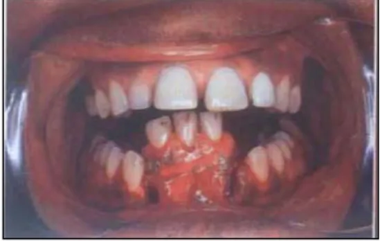 Gambar 2. Gambaran Klinis Fraktur  Dentoalveolar. 