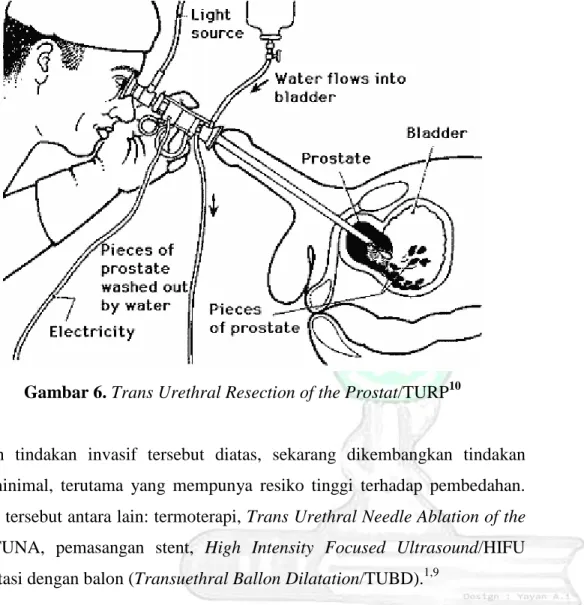 Gambar 6. Trans Urethral Resection of the Prostat/TURP 10 