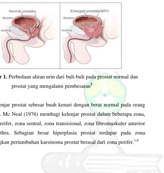 Gambar 1. Perbedaan aliran urin dari buli-buli pada prostat normal dan  prostat yang mengalami pembesaran 5   