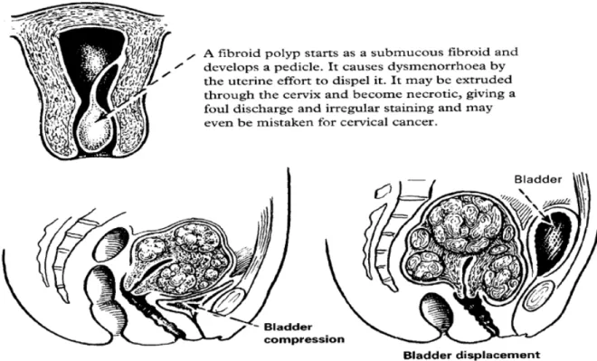 Gambar 2.3 Komplikasi Mioma Uteri  (Sumber: Hart D.M, Norman J, 2000) 