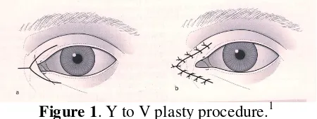 Figure 1. Y to V plasty procedure.1 