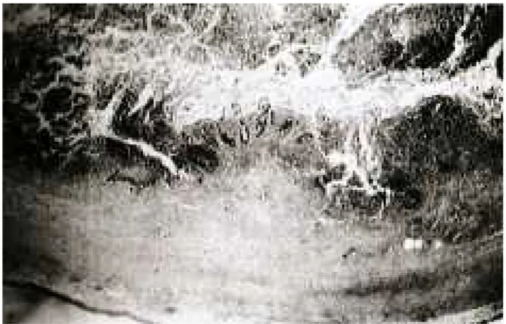 Gambar 2.2. Mikroskopis apendisitis akut supuratif. Tampak infiltrat inflamasi akut transmural disertai dengan ulserasi mukosa, pus intraluminal dan serositis