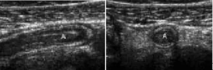 Gambar 2.4. Gambaran ultrasonografi apendisitis akut. (a) Axis memanjang dan (b) Potongan melintang (Birnbaum dan Wilson, 2000)